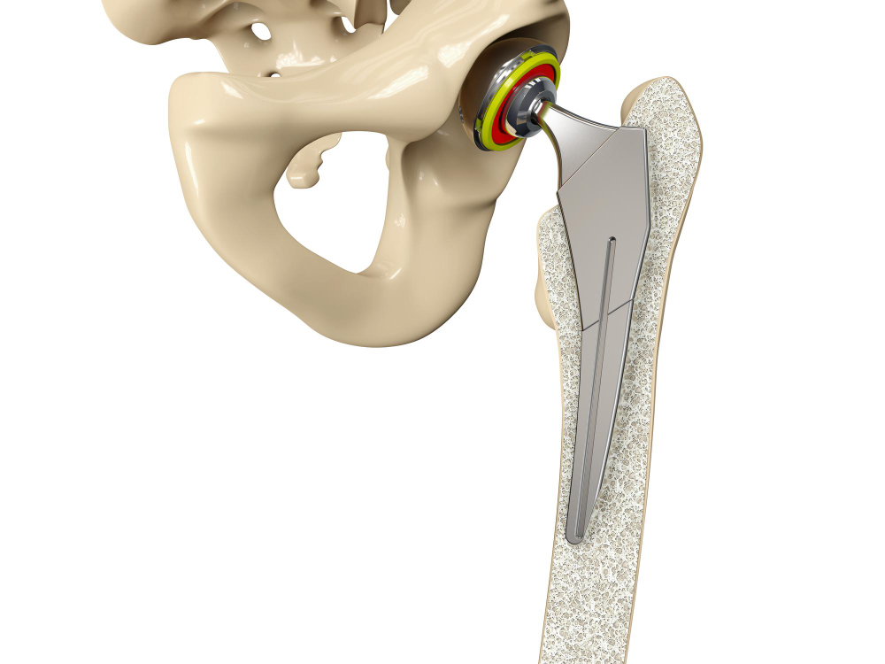 Joint Replacement Surgery